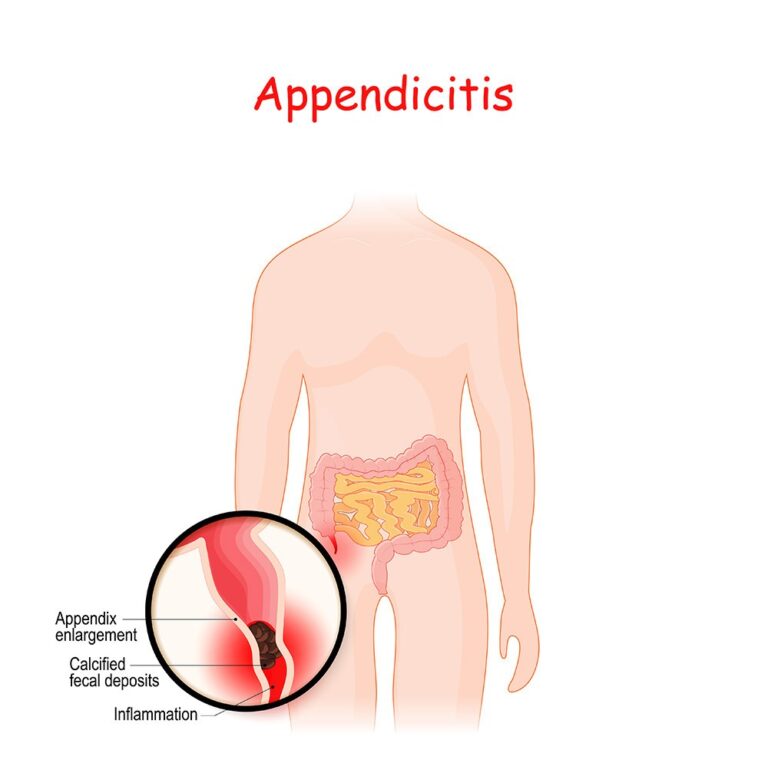 Laparoscopic Appendix Surgery - Barioss Centre