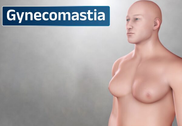 Gynecomastia Causes, Symptoms & Why Male Breast Reduction Surgery Is the Best Solution Gynecomastia Causes, Symptoms & Why Male Breast Reduction Surgery Is the Best Solution