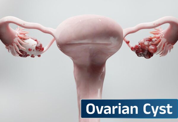 Laparoscopic Cyst Removal The Safest, Most Precise & Scarless Way to Remove Abdominal and Ovarian Cysts Laparoscopic Cyst Removal The Safest, Most Precise & Scarless Way to Remove Abdominal and Ovarian Cysts