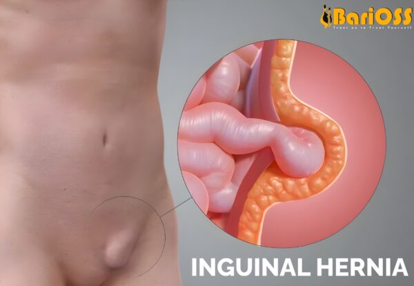 Ingunial Hernia